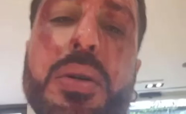 Si taglia le vene per protesta. Così Fabrizio Corona minaccia i giudici