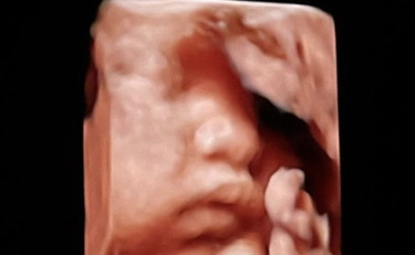 Chiara Ferragni fa vedere l'ecografia. Il nomignolo che dà alla piccola è dolcissimo