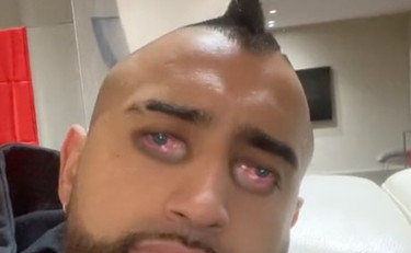 Come si è ridotto Arturo Vidal: che paura su TikTok