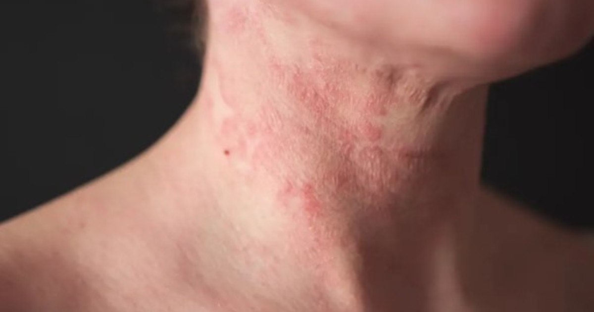 Quando lo stress arriva alla pelle: il circuito che la scienza ha appena scoperto