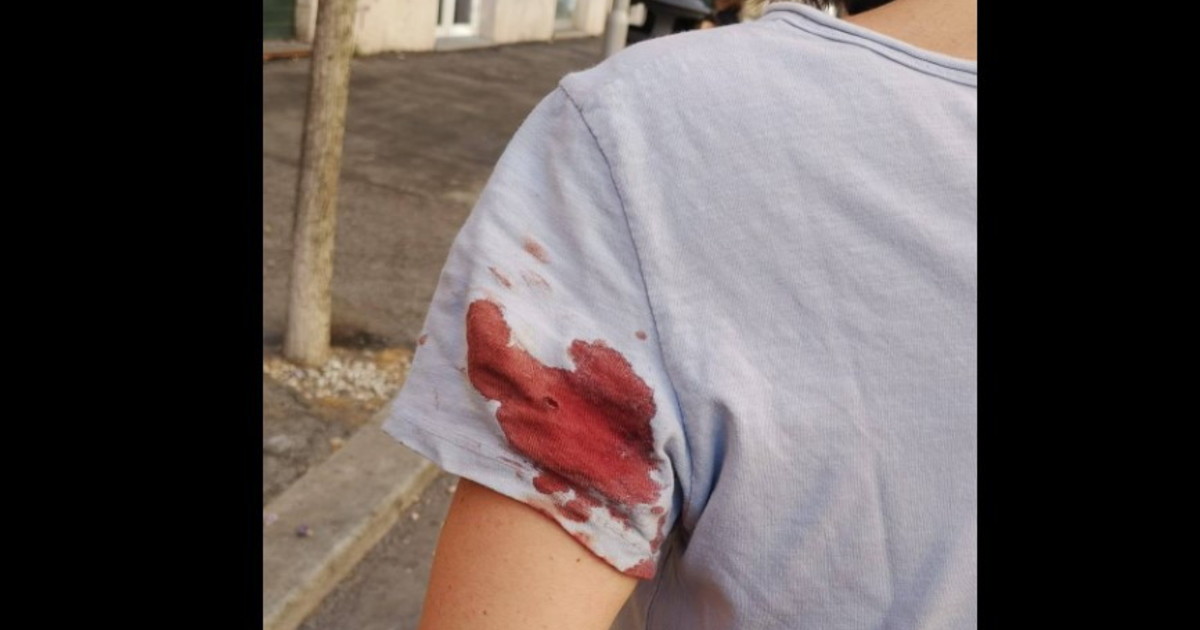 Paura a Prati, ancora spari da pistola ad aria compressa contro i passanti: Dolore fortissimo e sangue